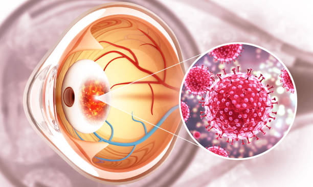 macular edema treatment
